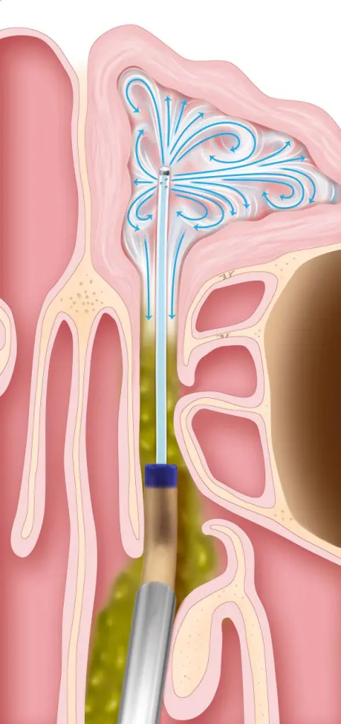 Balloon Sinuplasty Walled Lake, Michigan Step 3