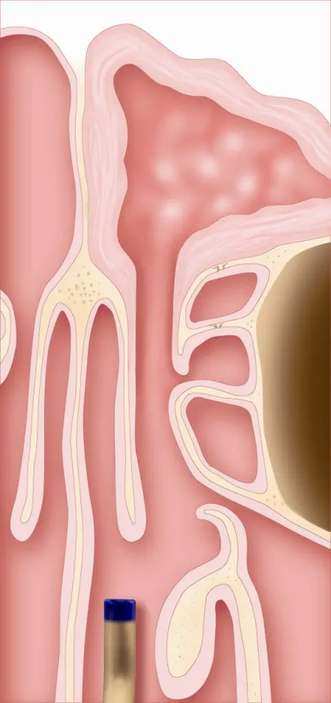 Balloon Sinuplasty Walled Lake, Michigan Step 4